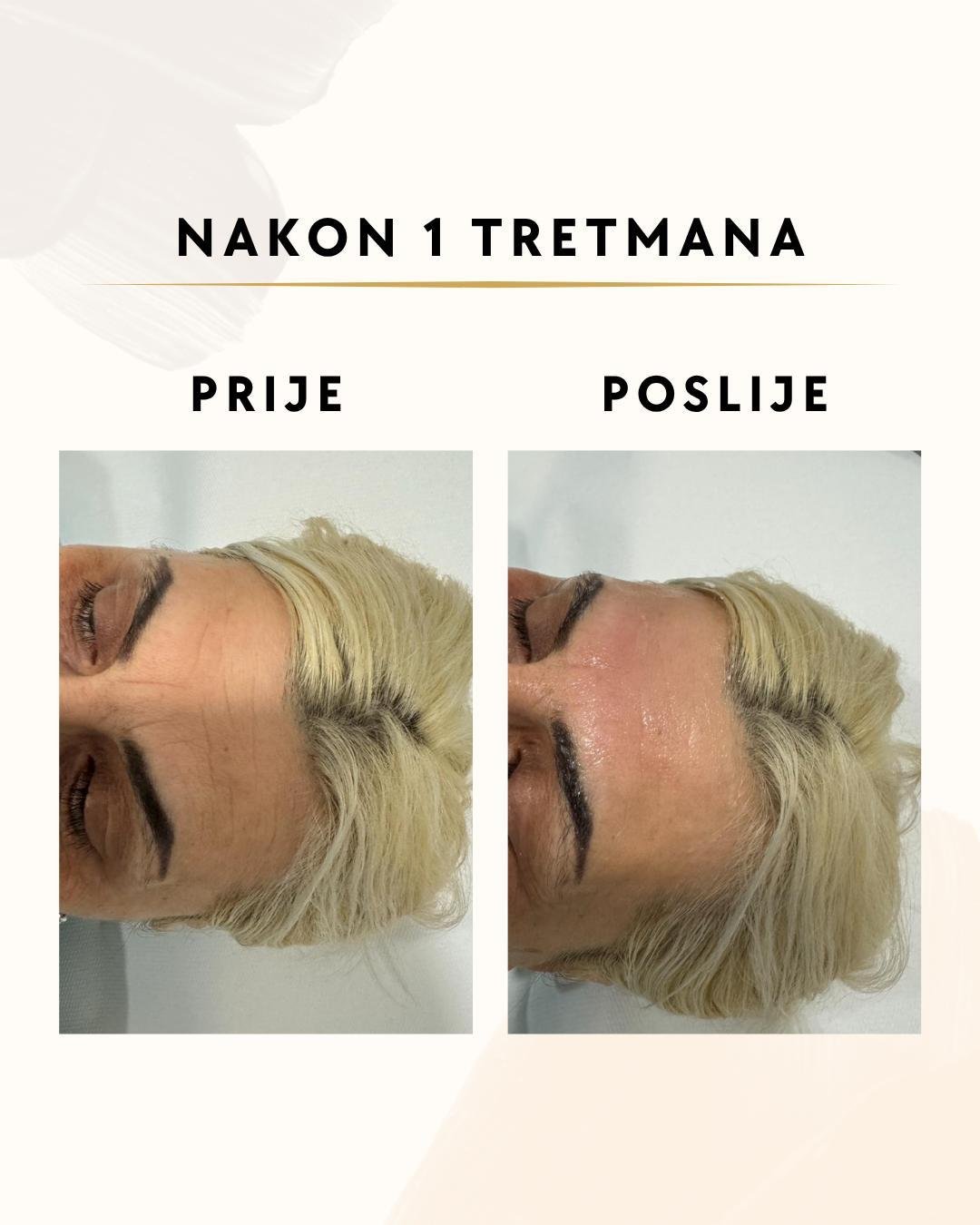 Bore na čelu - 1 tretman