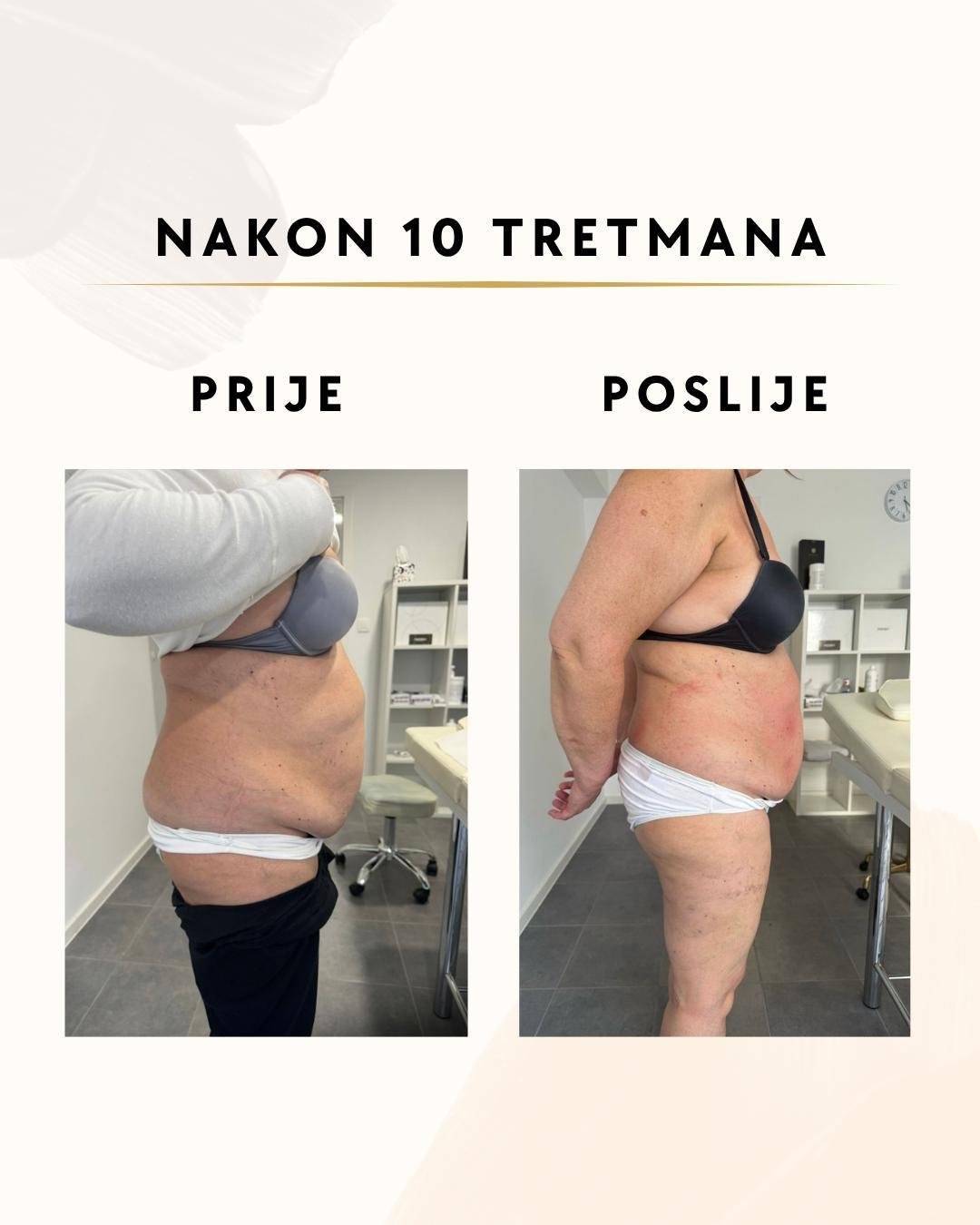 Tretmani za mršavljenje - 10 tretmana