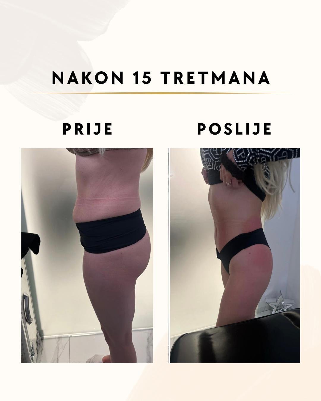 Tretmani za mršavljenje - 15 tretmana